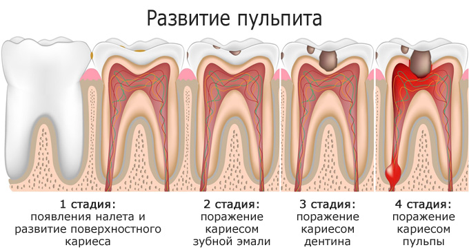 Лечение пульпита Томск Больничная Сложное удаление зуба Томск Нефтяная
